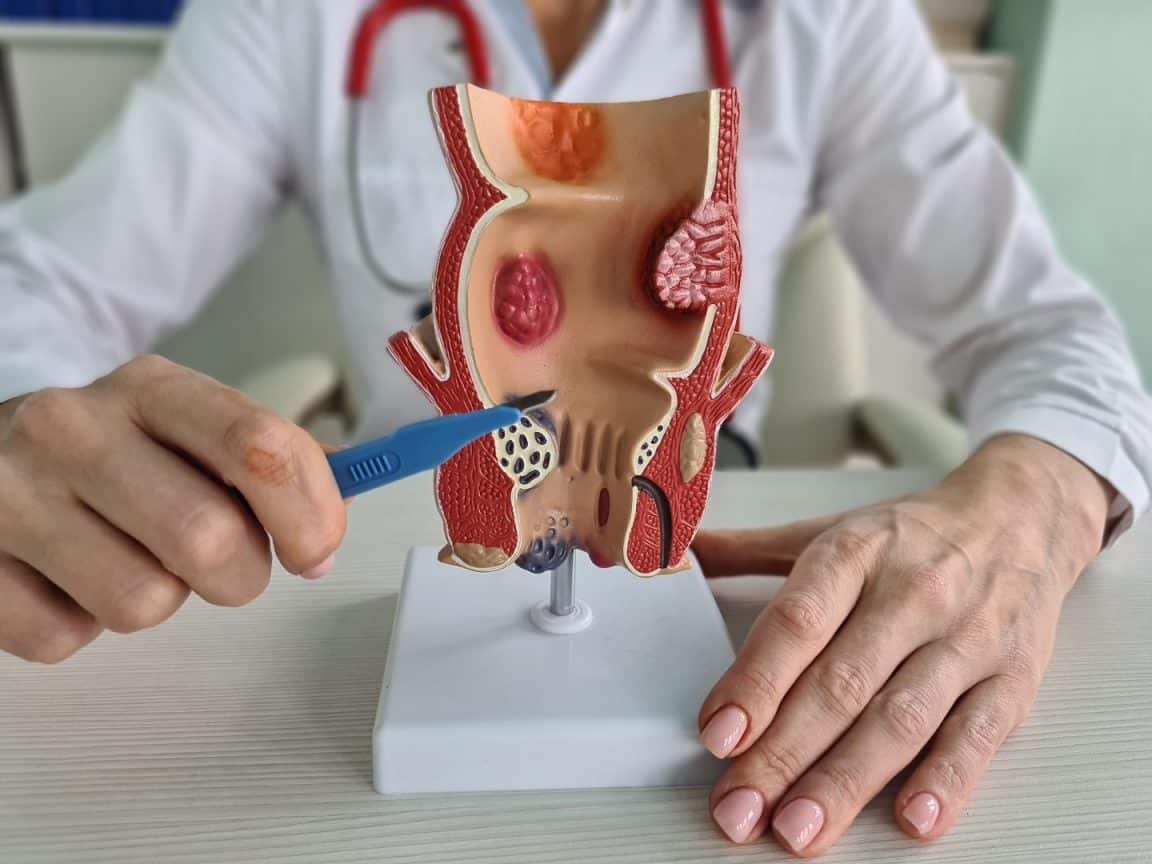 Ce sunt hemoroizii, de ce apar, cum se manifestă și care este tratamentul potrivit