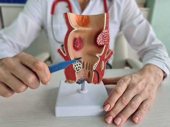 Ce sunt hemoroizii, de ce apar, cum se manifestă și care este tratamentul potrivit