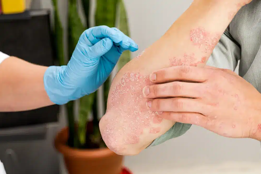 Medic consulta un pacient cu psoriazis