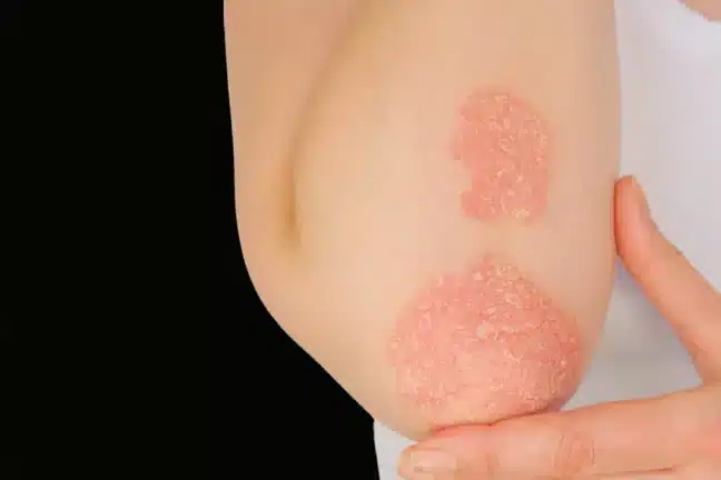 piele afectata de psoriazis